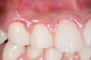 gingivitis