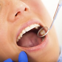 dental filings and dental sealants