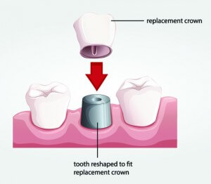 Understanding Dental Crowns