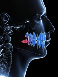 Wisdom Teeth - Should They Stay or Go