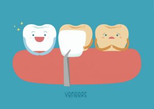 Dental Veneers