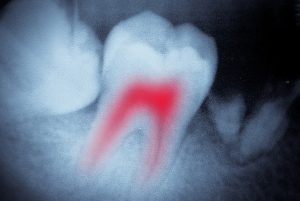 Root Canal Surgery