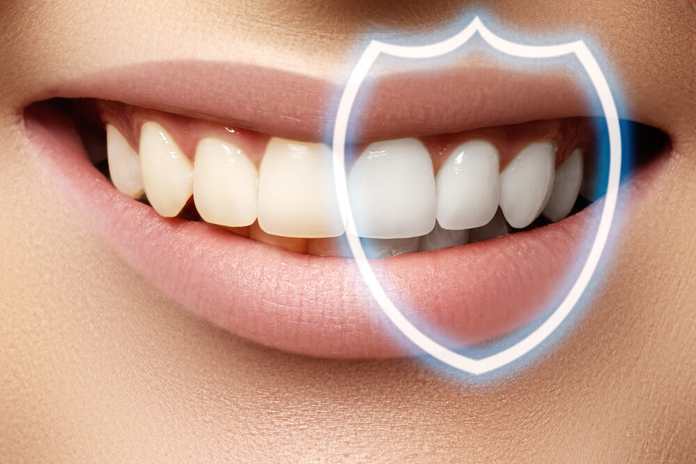 What Is A Dental Bonding EDP Dental What Is A Dental Bonding EDP Dental